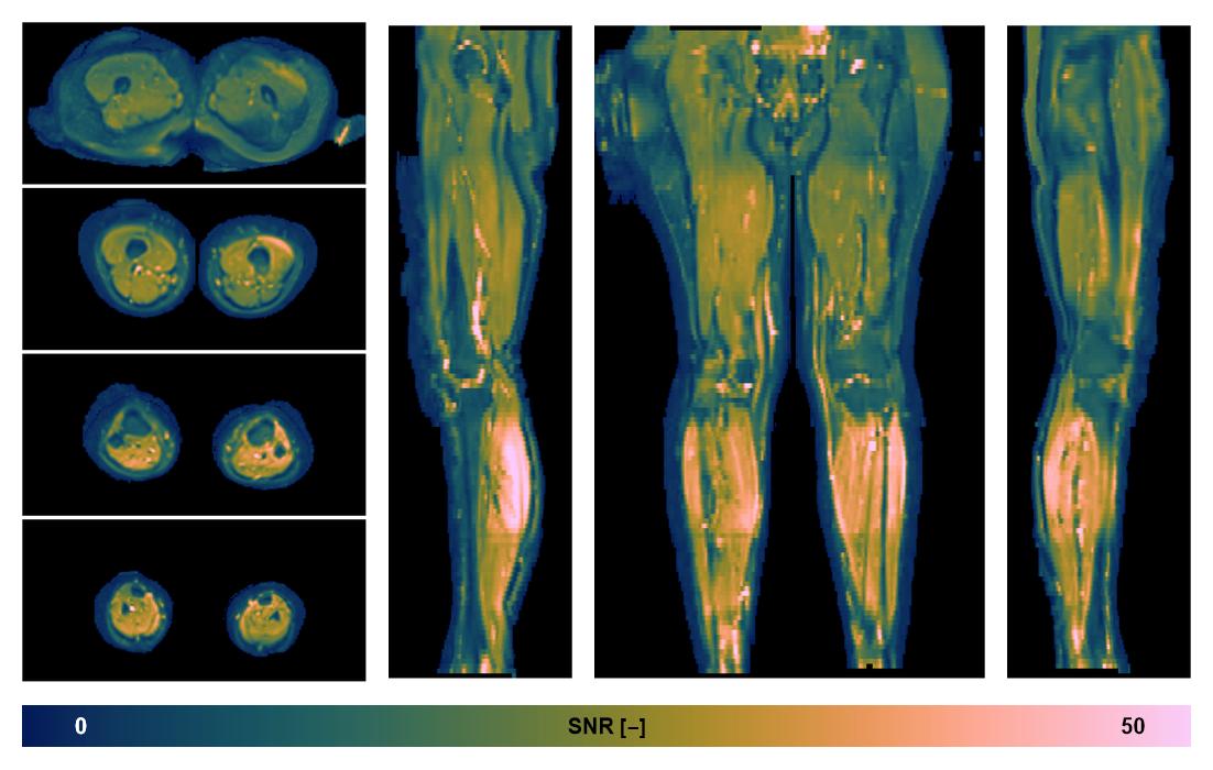 SNR distribution of the unweighted diffusion data.